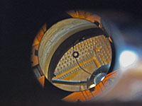 Collimation Step 2